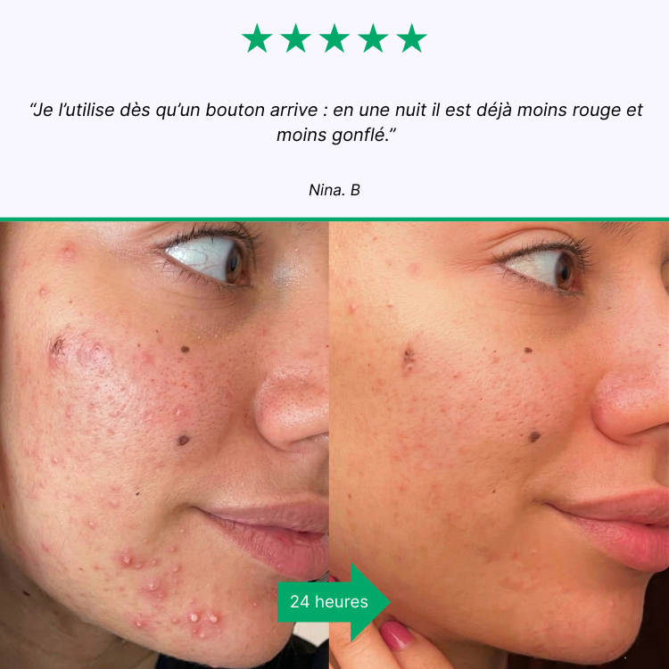 SOS Näppylät - Akneihon hoito