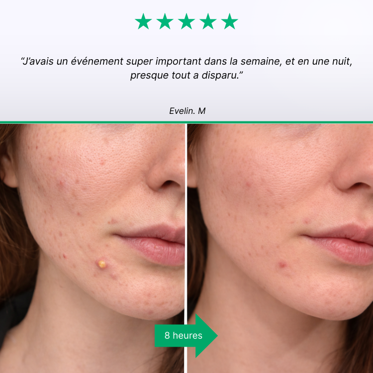 SOS Näppylät - Akneihon hoito