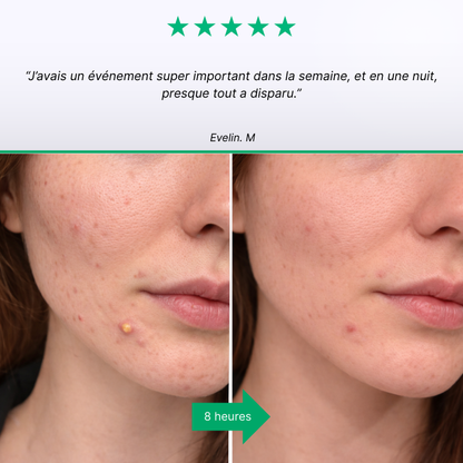 SOS Näppylät - Akneihon hoito