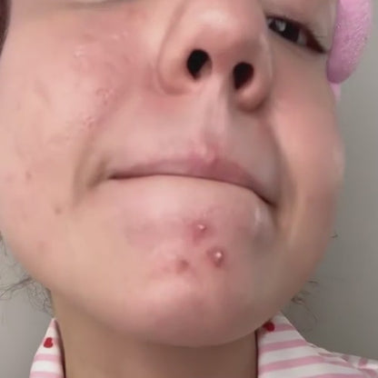 SOS Näppylät - Akneihon hoito